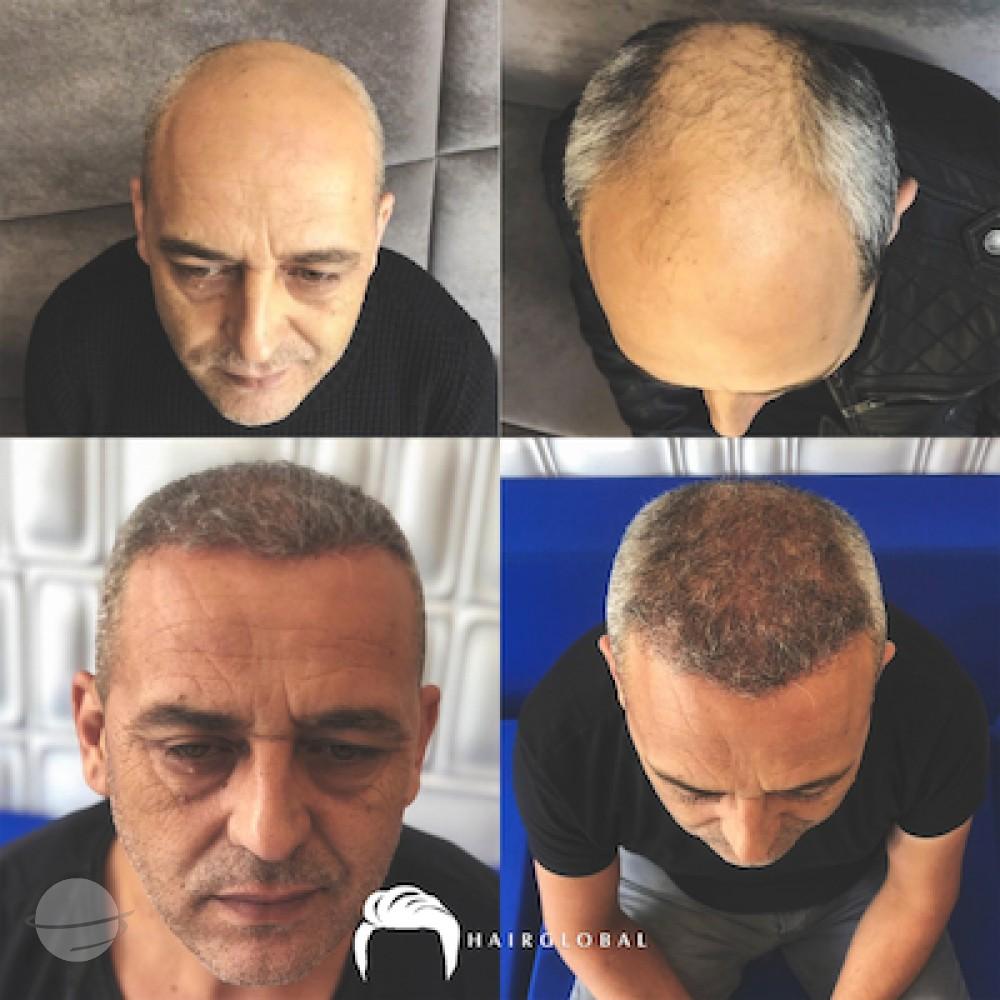 HairGlobal hair results5