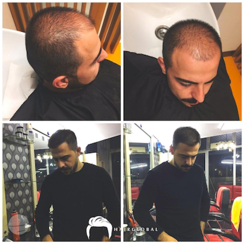 HairGlobal hair results2