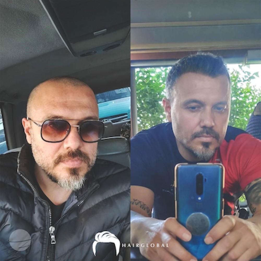 HairGlobal hair results12