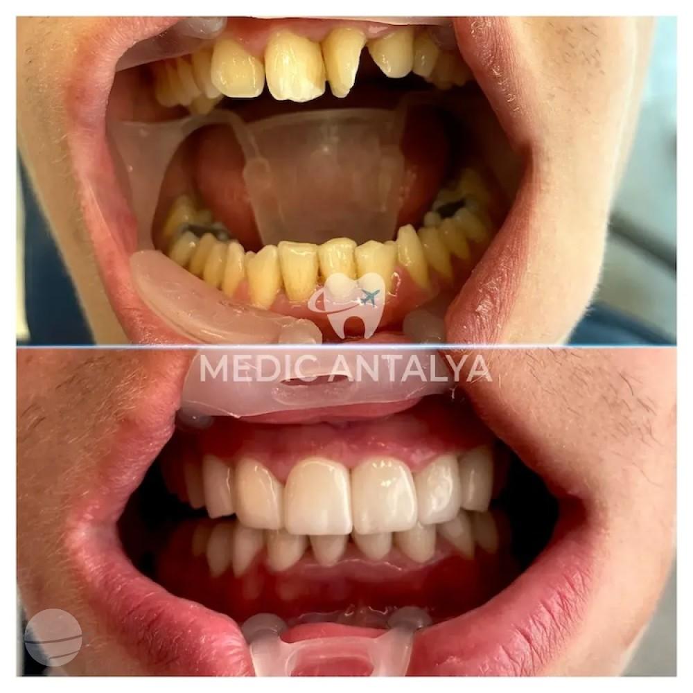 Medic antalya - Dental results11