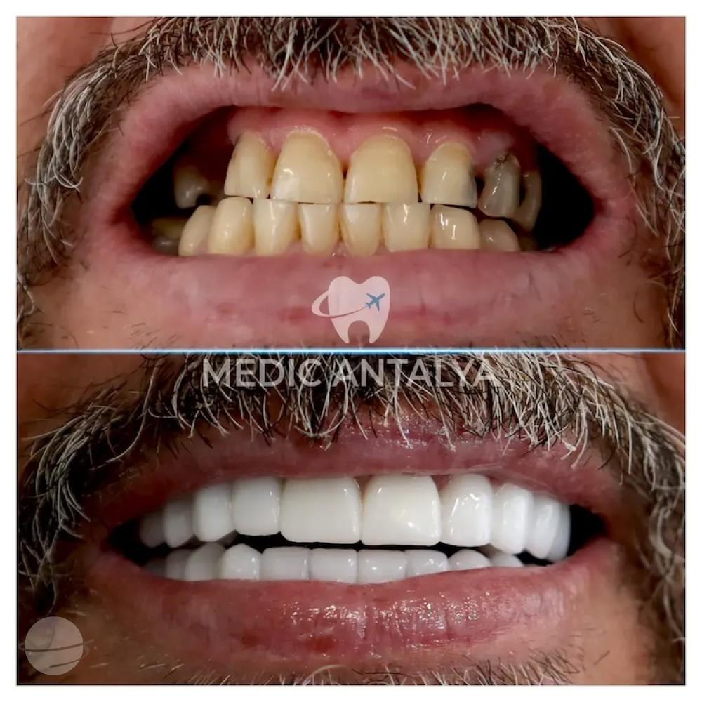 Medic antalya - Dental results12