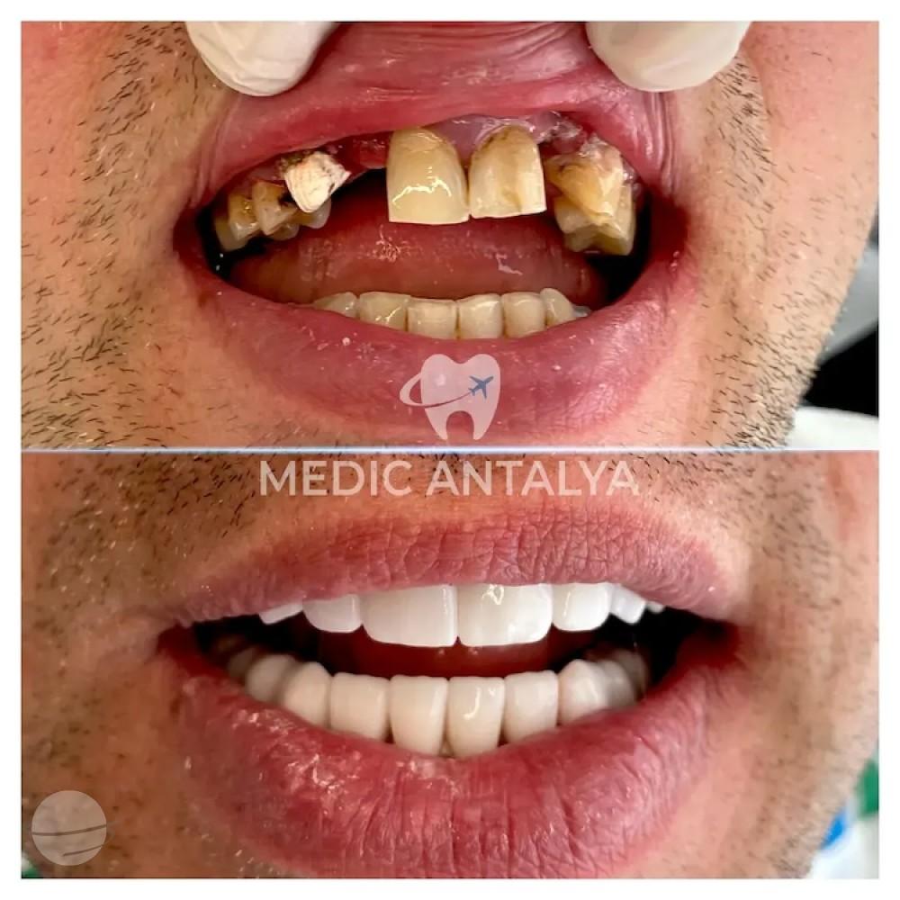 Medic antalya - Dental results14