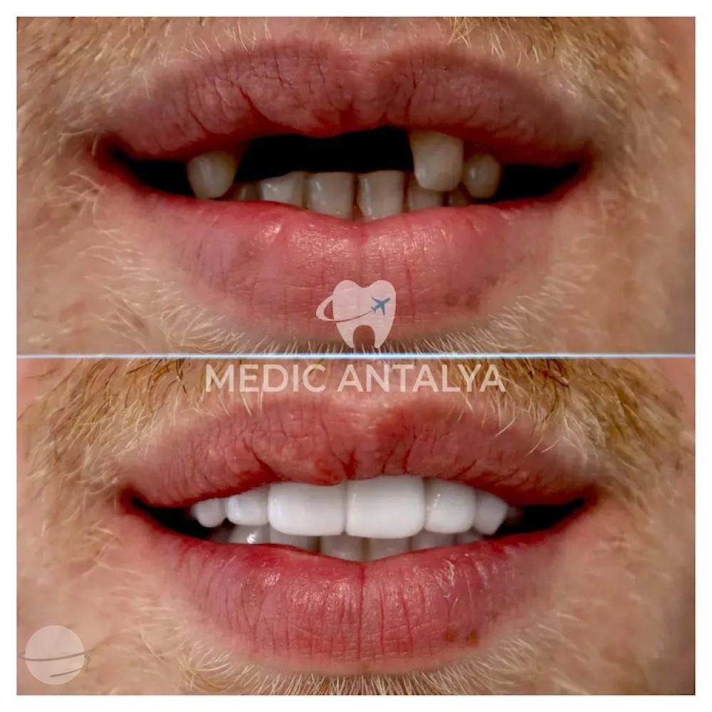 Medic antalya - Dental results18
