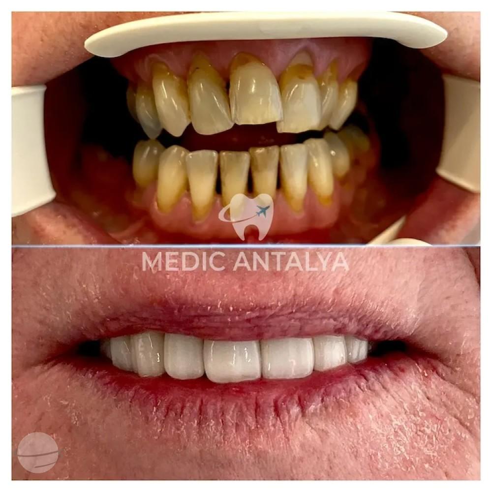 Medic antalya - Dental results19
