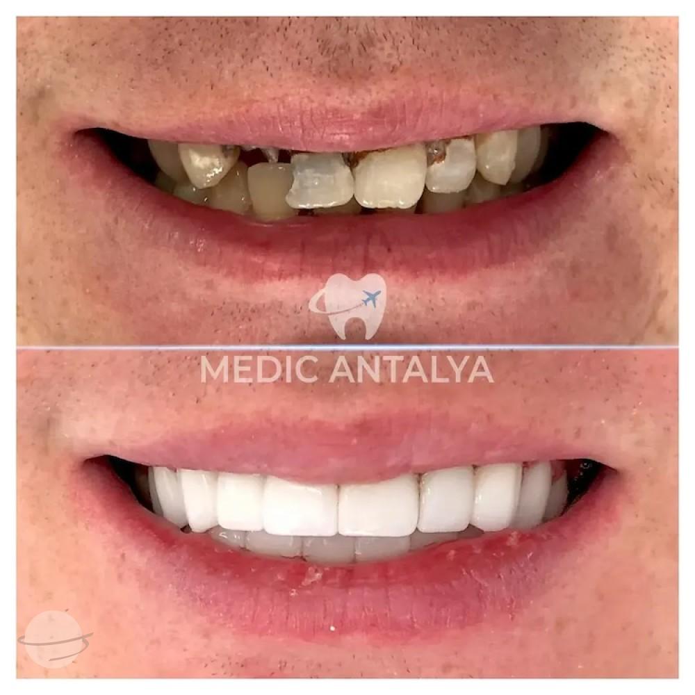 Medic antalya - Dental results23