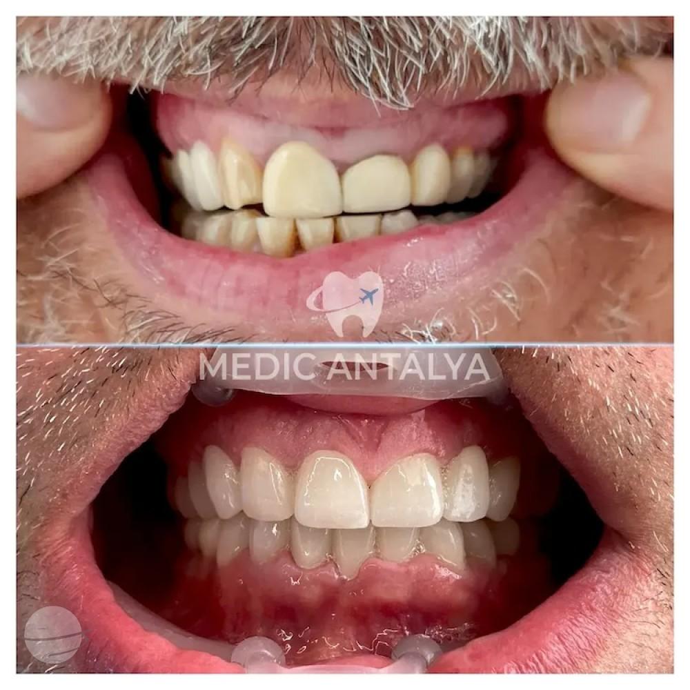 Medic antalya - Dental results30