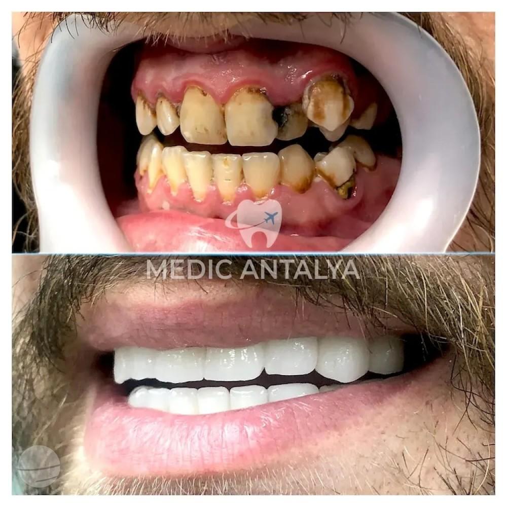 Medic antalya - Dental results32