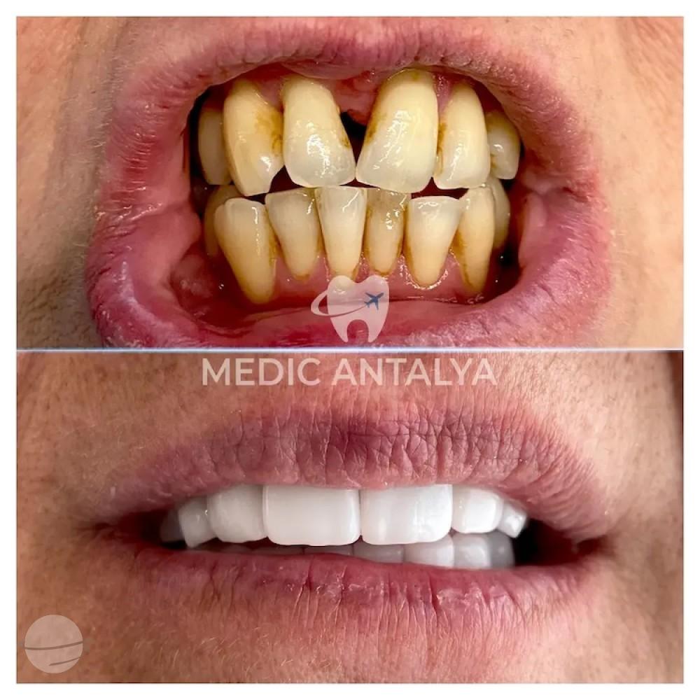 Medic antalya - Dental results36