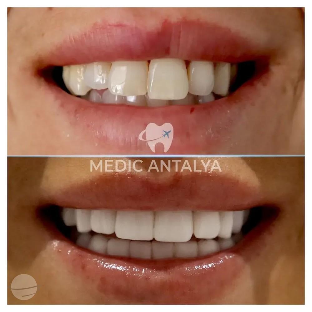 Medic antalya - Dental results6