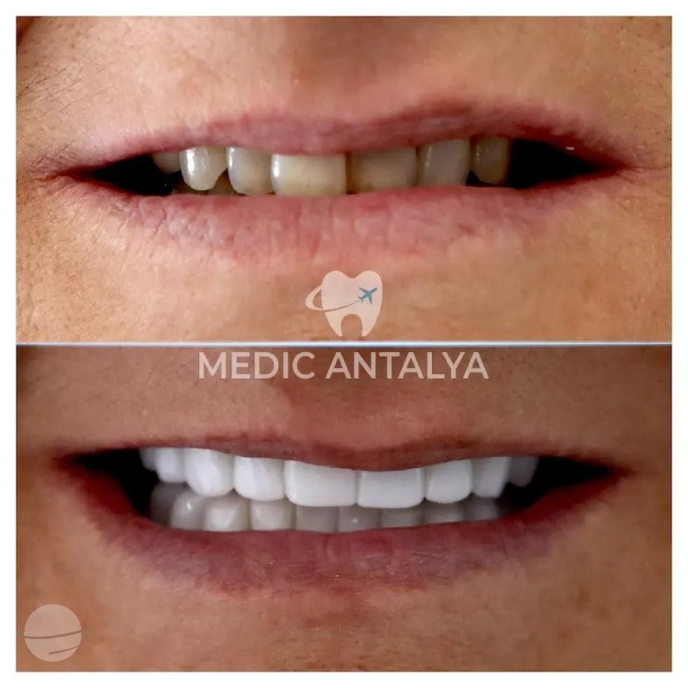Medic antalya - Dental results7