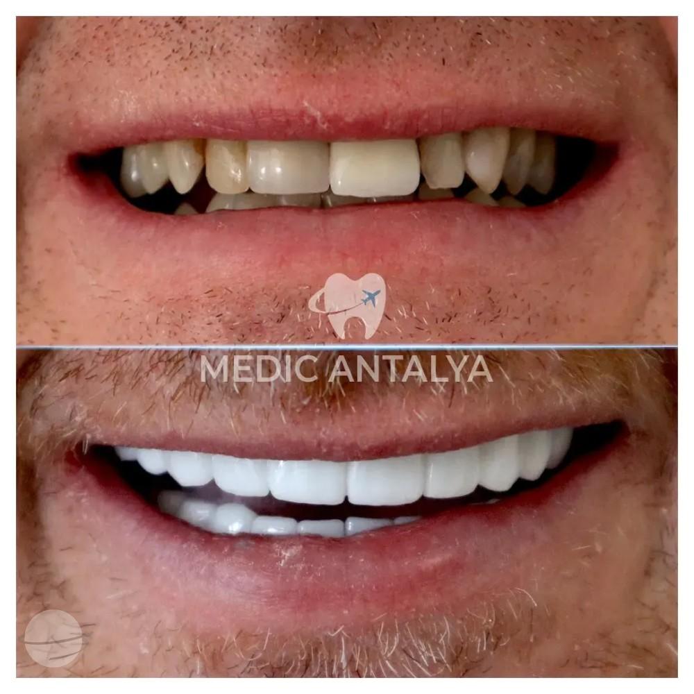 Medic antalya - Dental results8