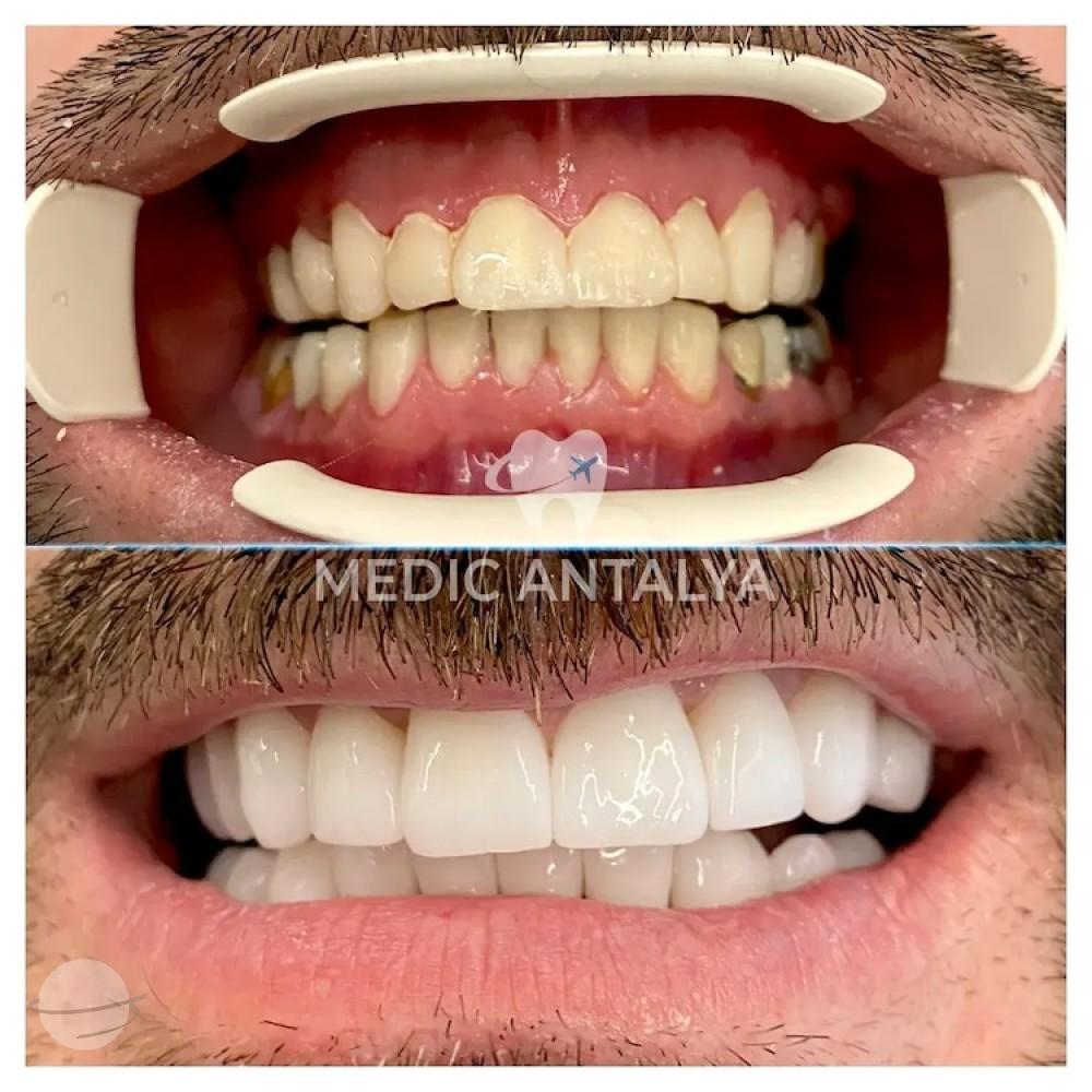 Medic antalya - Dental results17