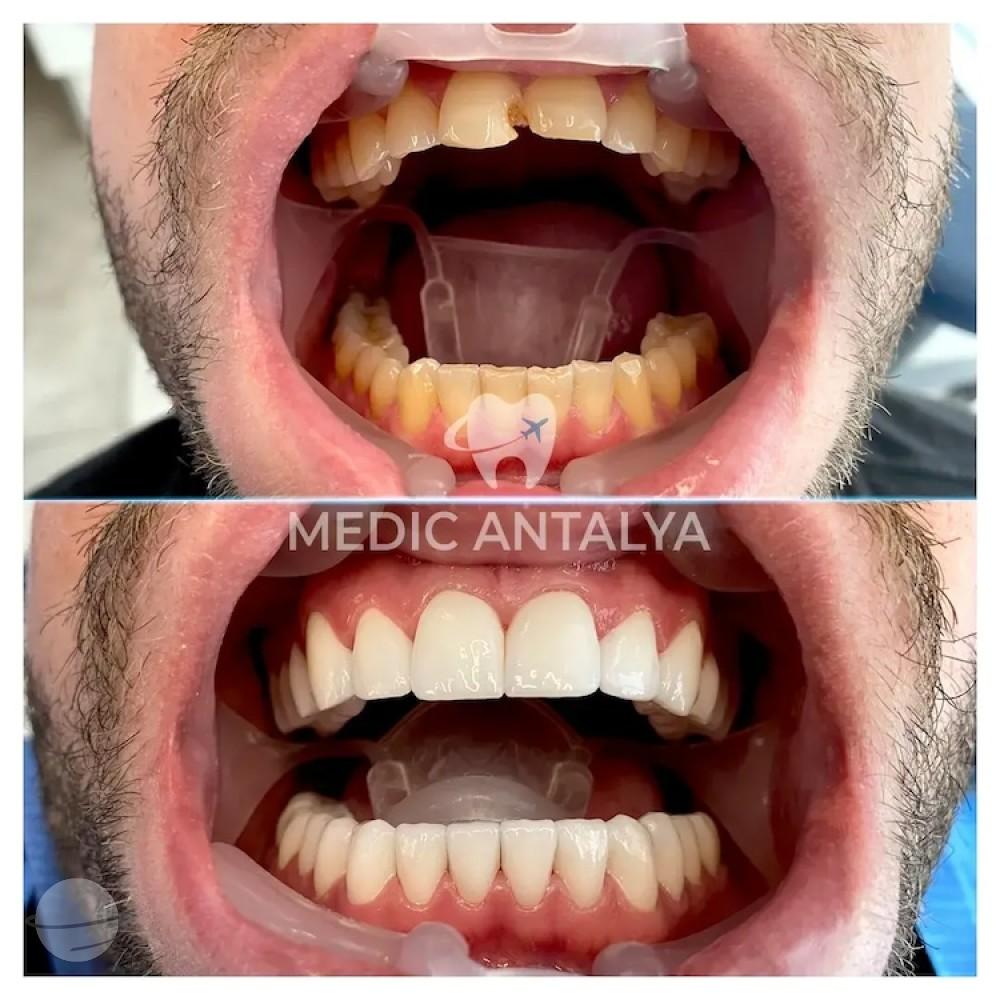 Medic antalya - Dental results21