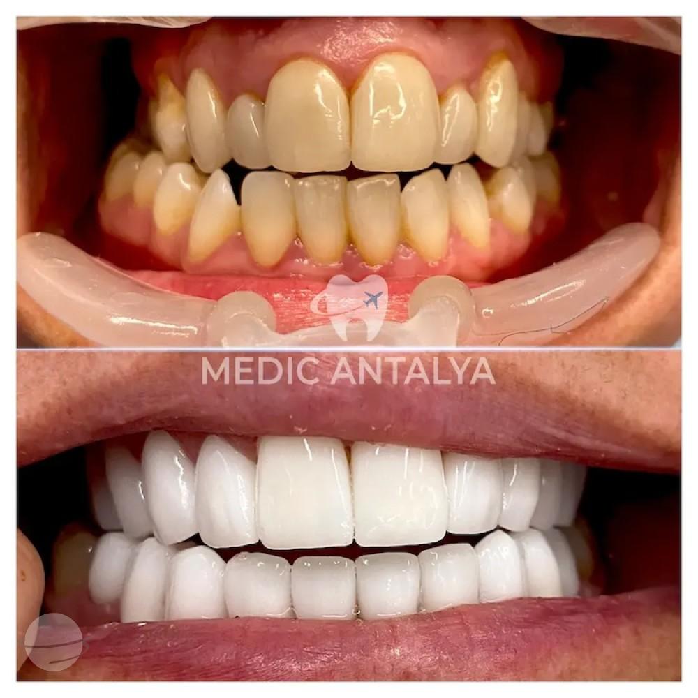 Medic antalya - Dental results22