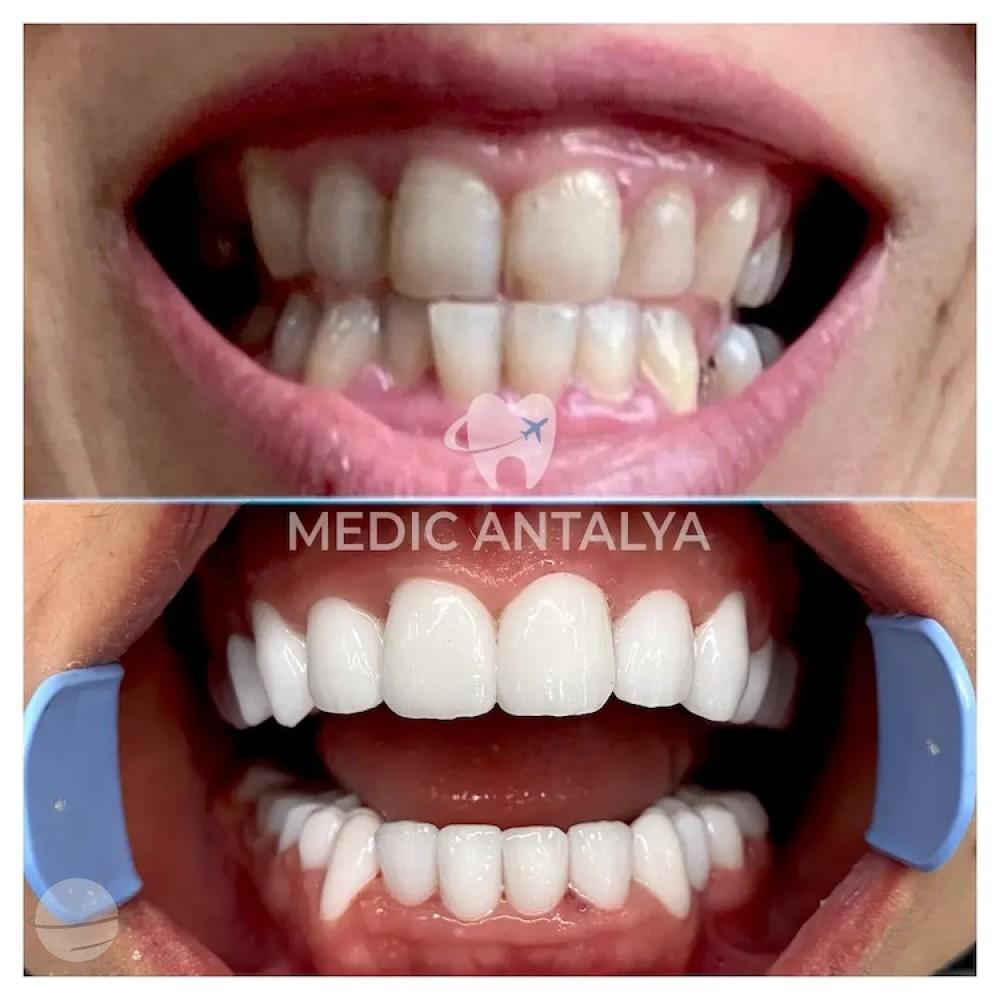 Medic antalya - Dental results27