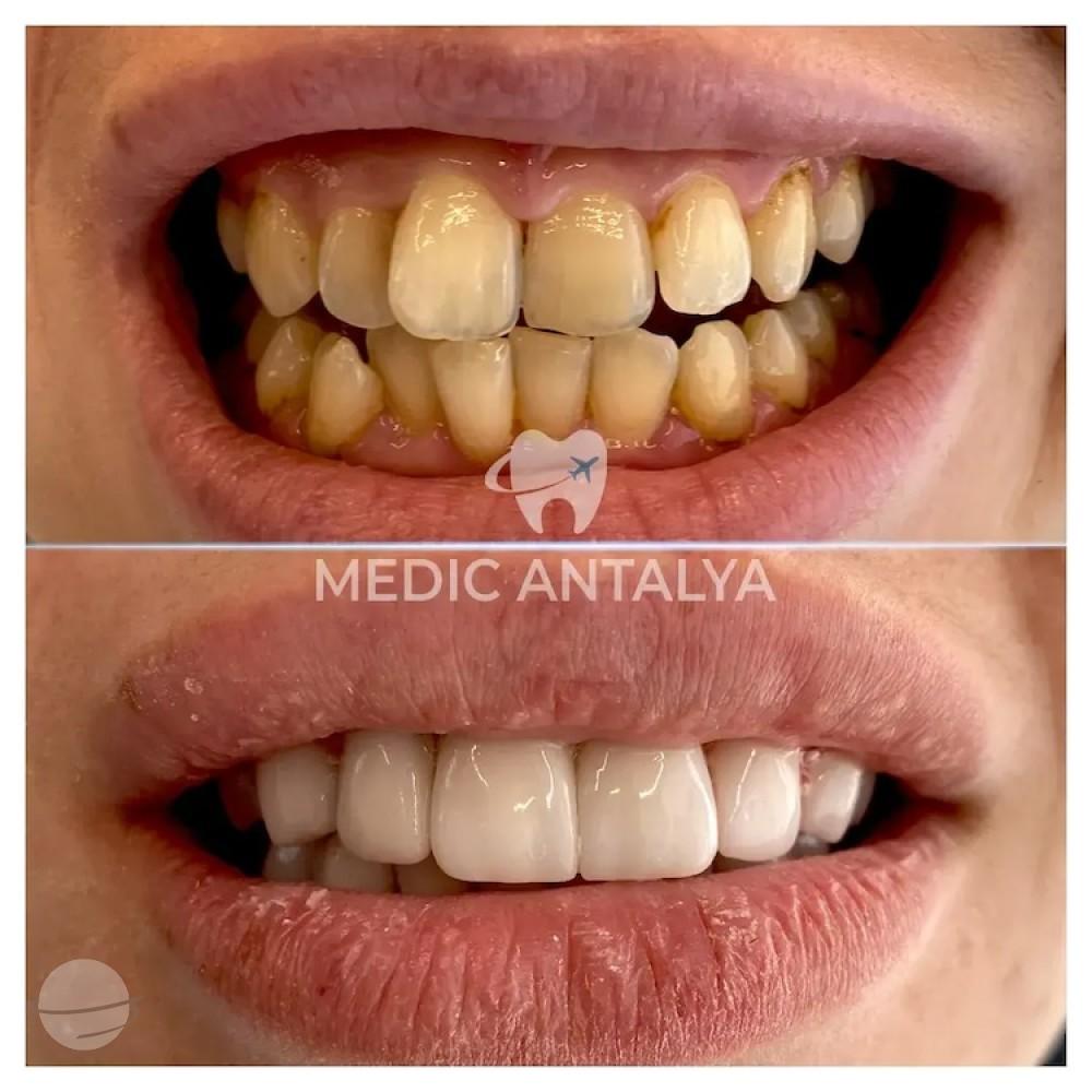 Medic antalya - Dental results29
