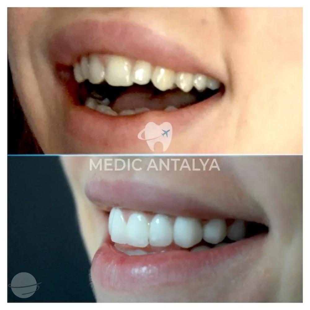 Medic antalya - Dental results31
