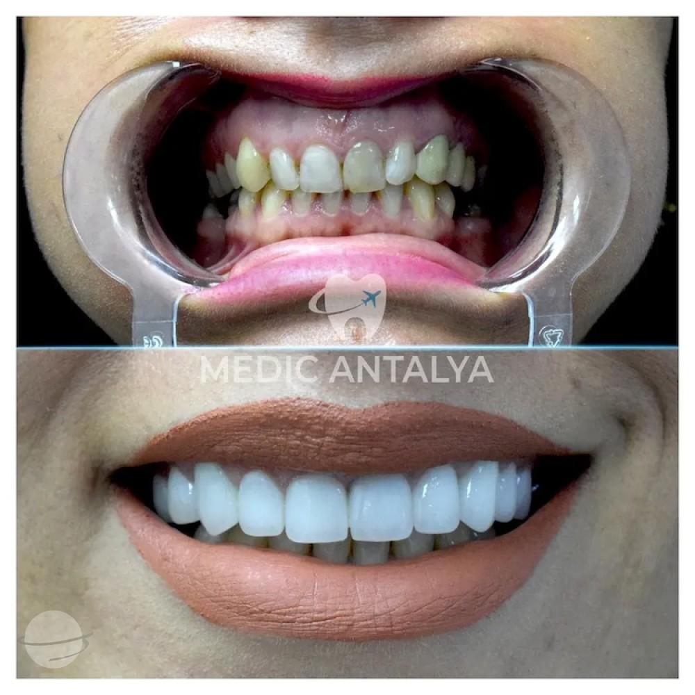 Medic antalya - Dental results33