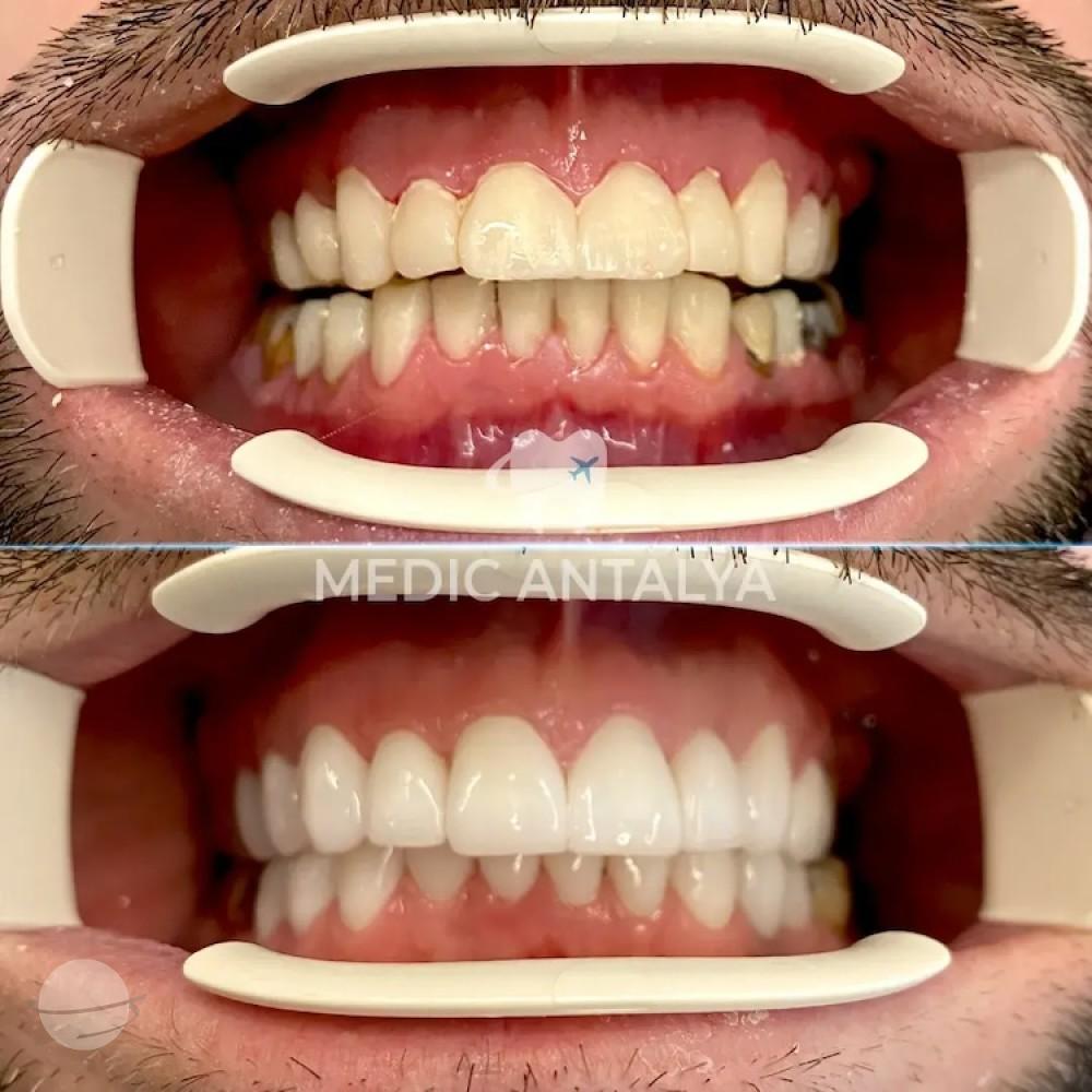 Medic antalya - Dental results34