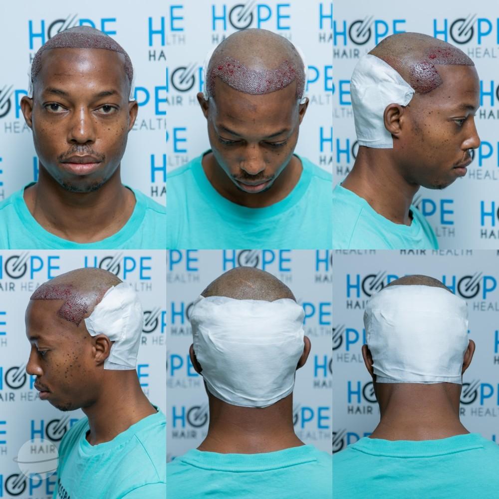 hope hair health - hair transplant results 19
