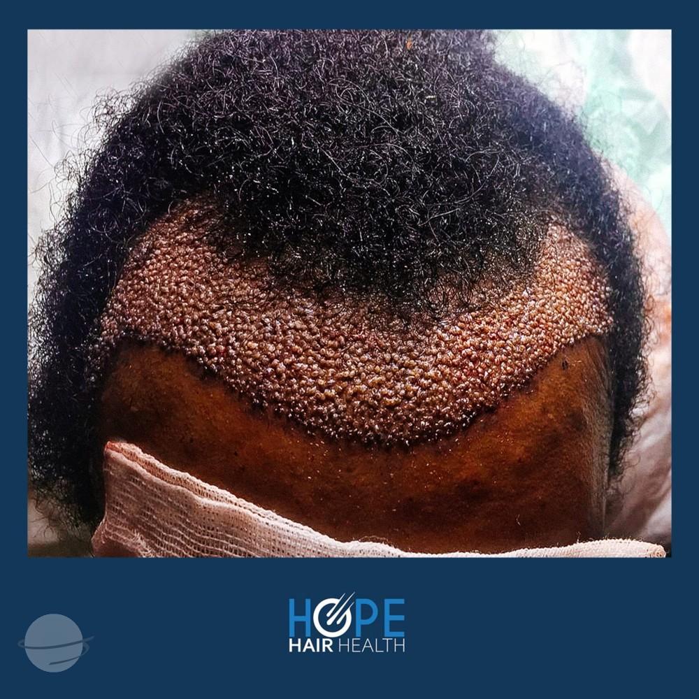 hope hair health - afro hair transplant results