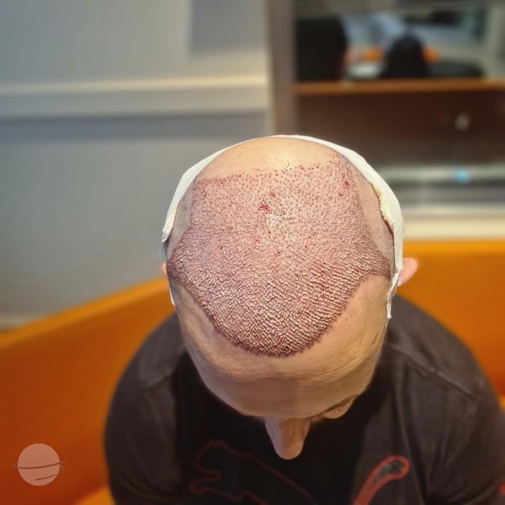 hope hair health - hair transplant results 17