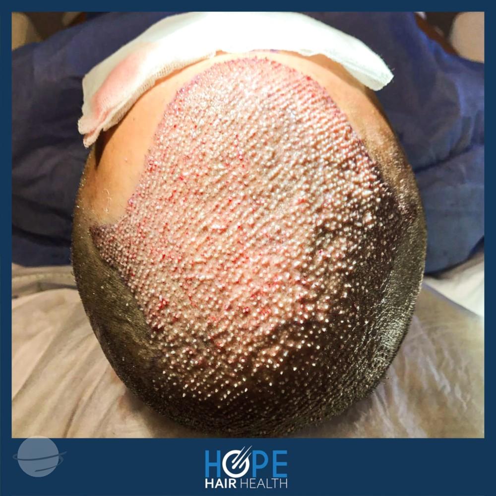 hope hair health - hair transplant results 13