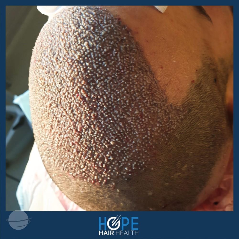 hope hair health - hair transplant results 14