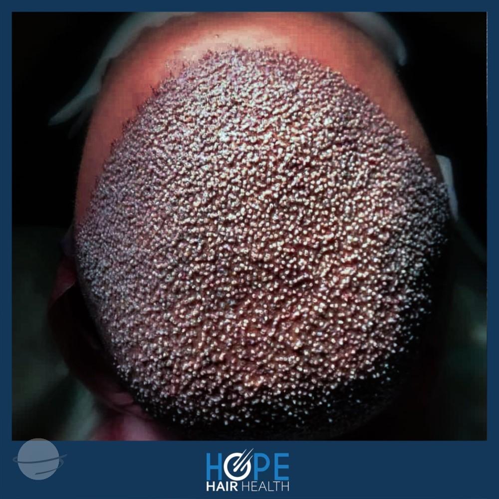 hope hair health - hair transplant results 16