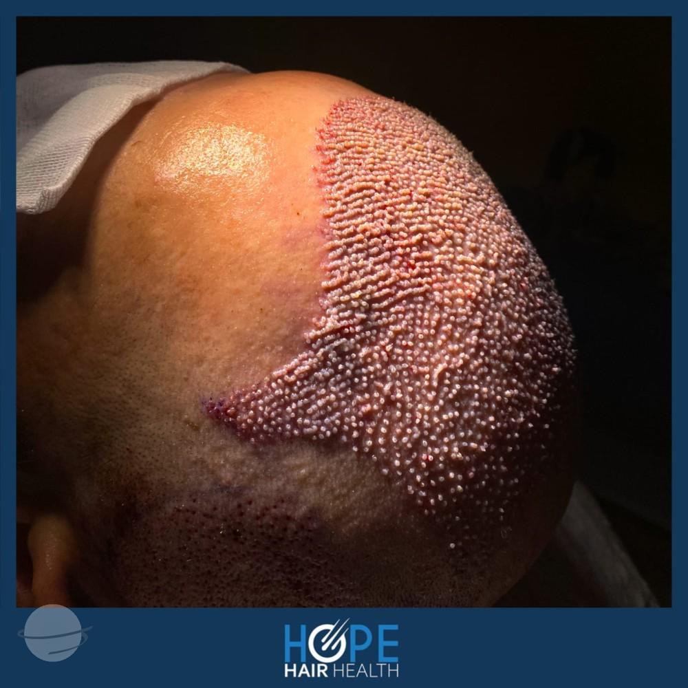 hope hair health - hair transplant results 10