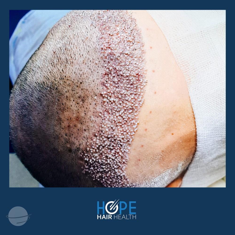 hope hair health - hair transplant results 2
