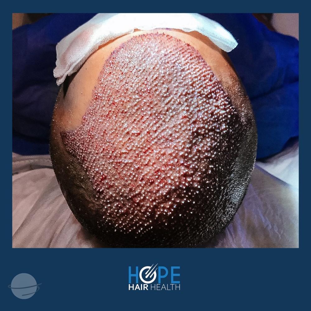 hope hair health - hair transplant results 3