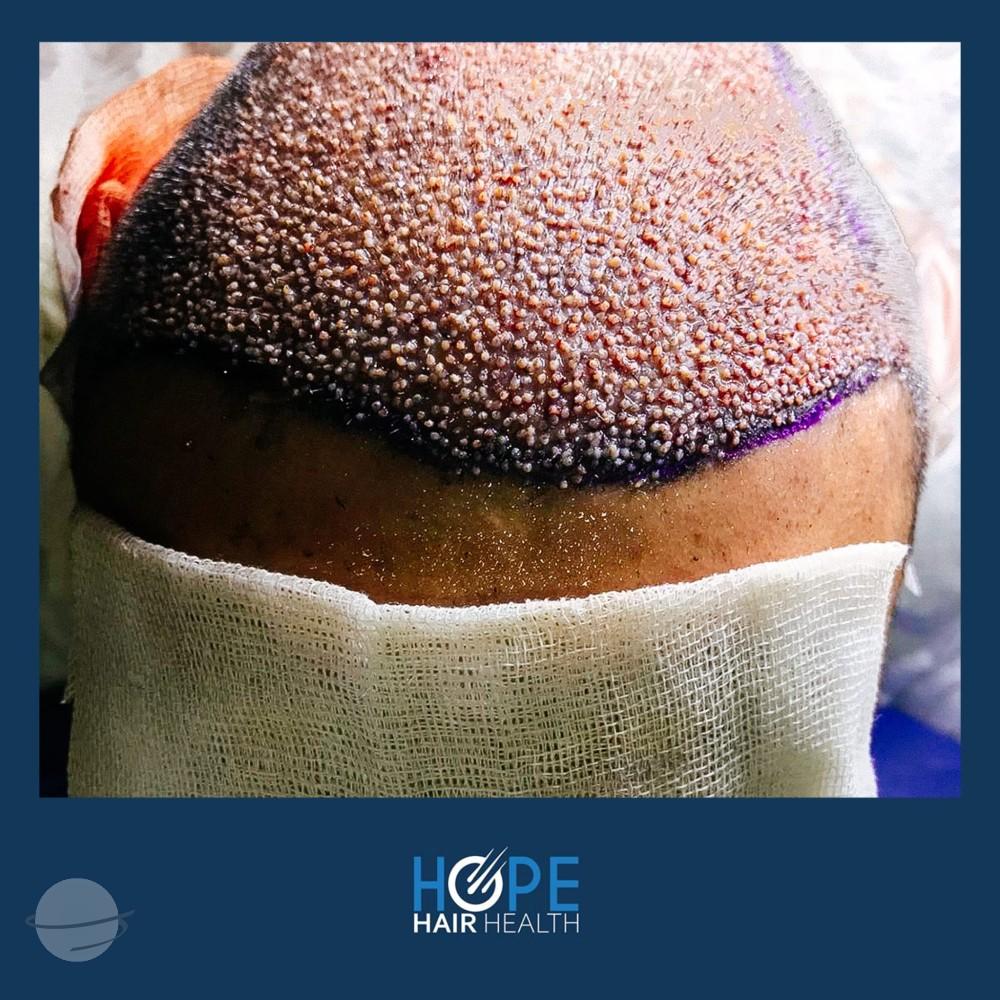 hope hair health - hair transplant results 6