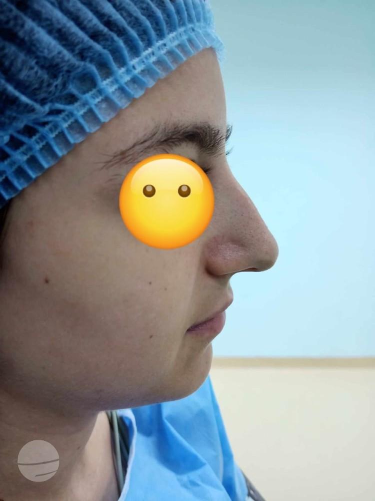 RHINOPLASTIE TUNISIE ZAGHOUAN4