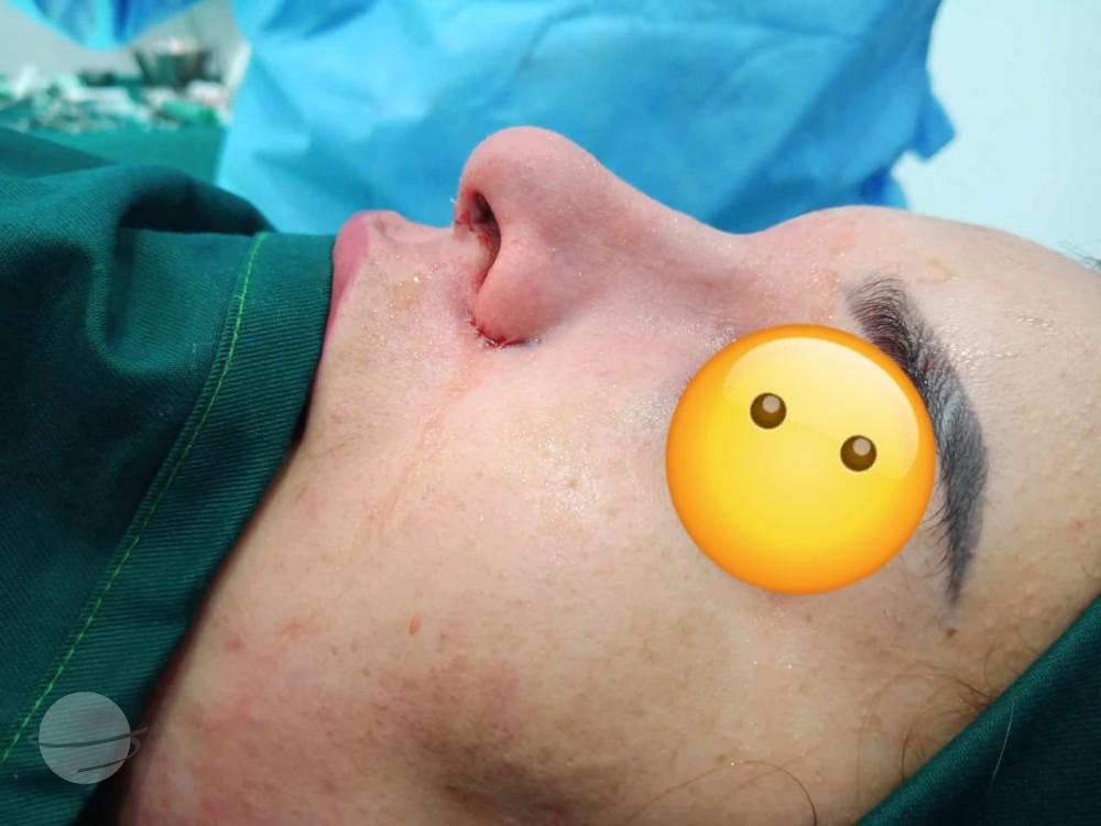 RHINOPLASTIE TUNISIE ZAGHOUAN3