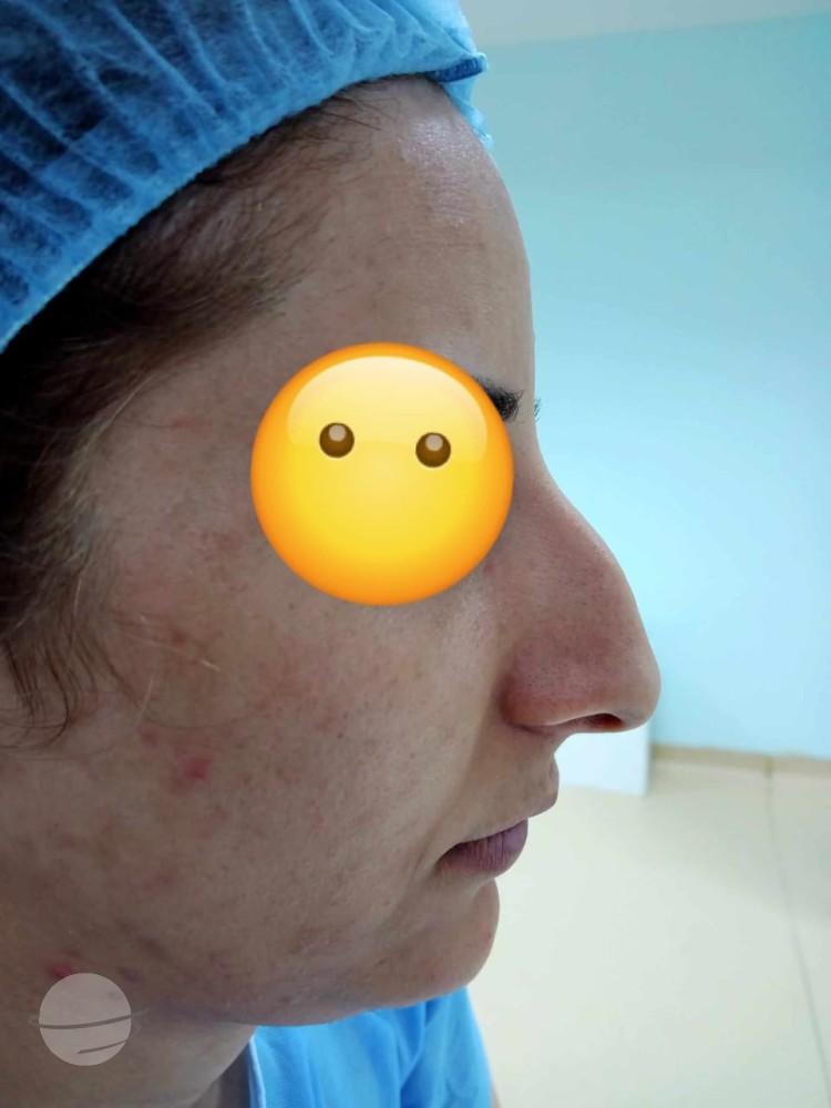 RHINOPLASTIE TUNISIE ZAGHOUAN2