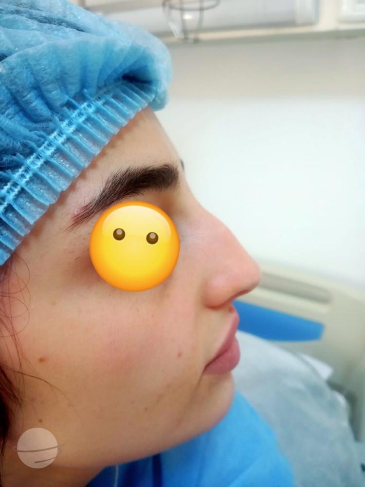 RHINOPLASTIE TUNISIE ZAGHOUAN6