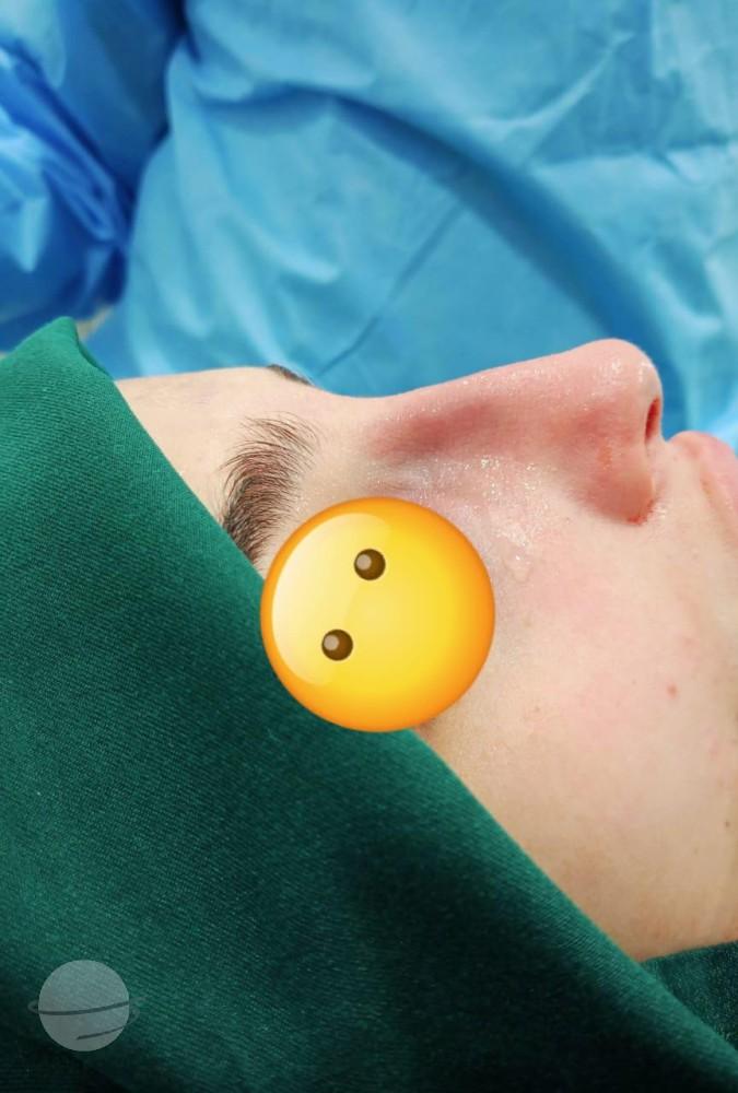 RHINOPLASTIE TUNISIE ZAGHOUAN7