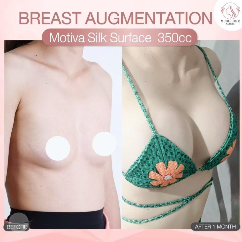Results breast augmentation Mediprim Clinic Bangkok 3