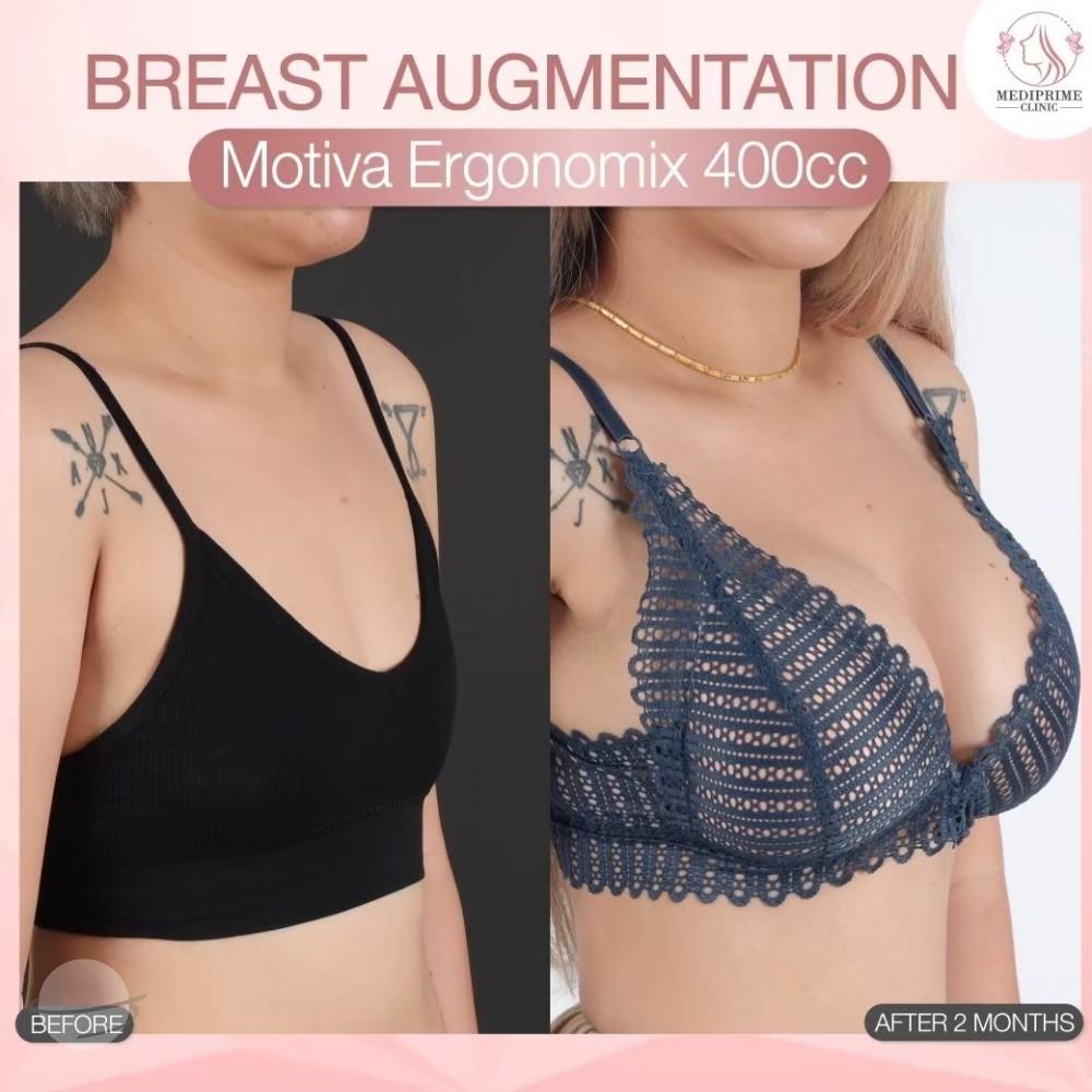 Results breast augmentation Mediprim Clinic Bangkok 8