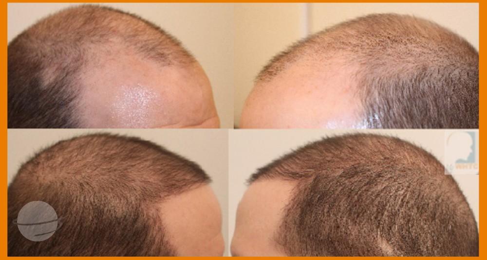 Dr Patrick Mwamba Hair transplant result