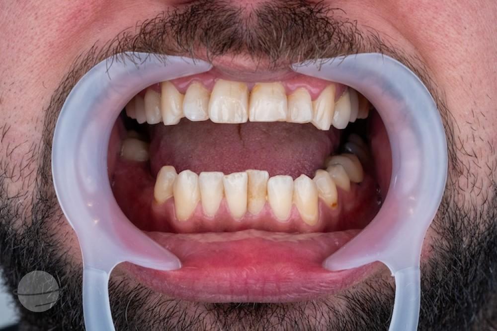 Before ZenSmileTown Dental Results30