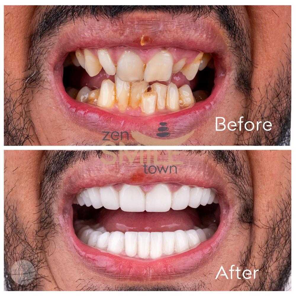 ZenSmileTown Dental Results9