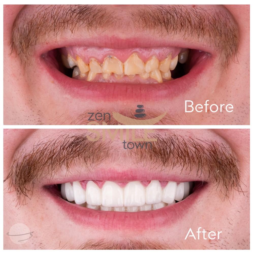 ZenSmileTown Dental Results20