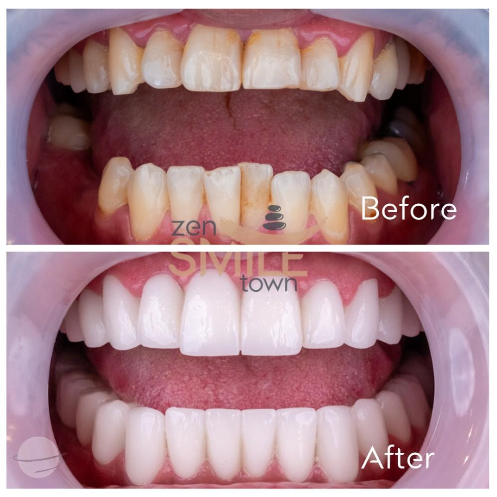 ZenSmileTown Dental Results23