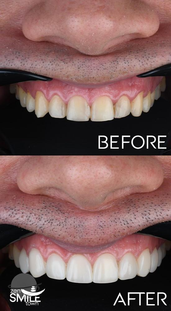 DENTAL TURKEY - COMPOSITE BONDING RESULTS2