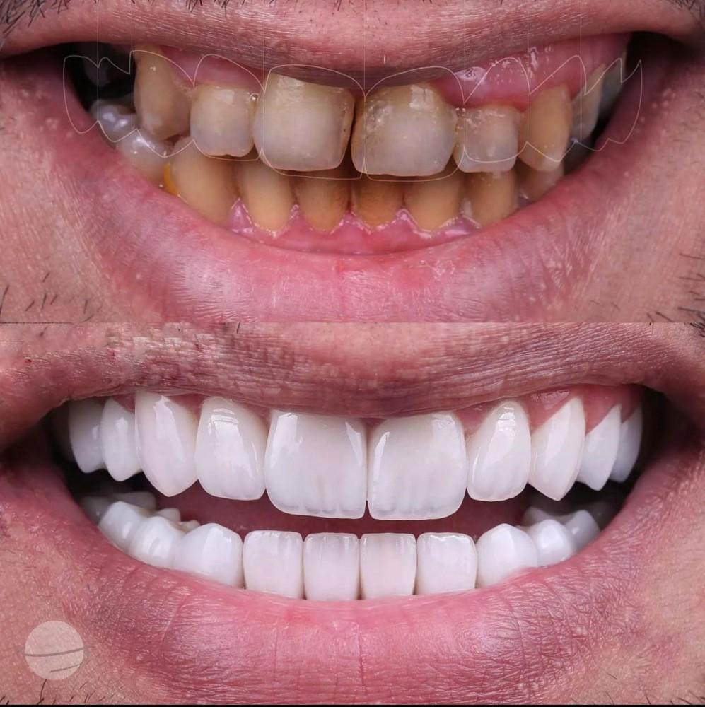 3- Before-after zirkon vaka