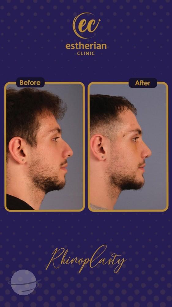 estherian Face Surgery 14-min