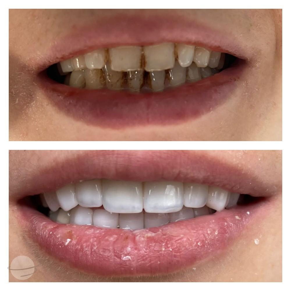 5- Before-after zirkon vaka