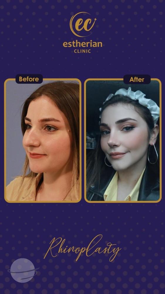 estherian Face Surgery 16-min